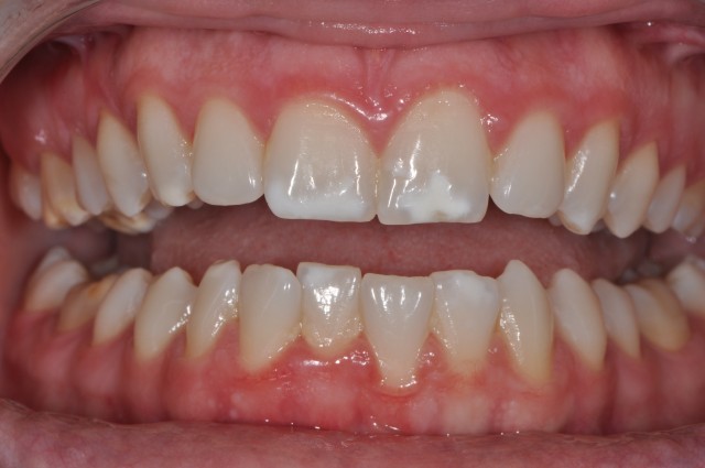 فلوئوروزیس دندانی چیست؟