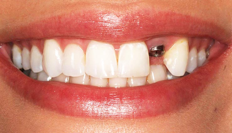 ایمپلنت دندان-rozhal.com